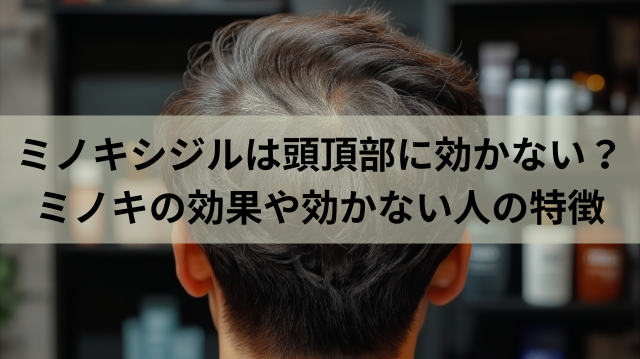 ミノキシジルは頭頂部に効かない？ミノキの効果や効かない人の特徴