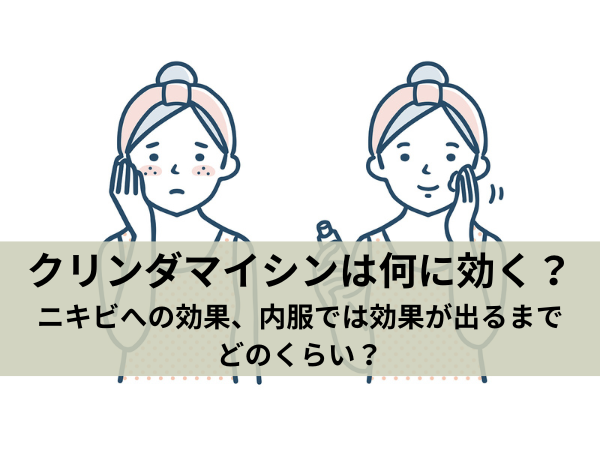 クリンダマイシンは何に効く？ニキビへの効果、内服では効果が出るまでどのくらい？