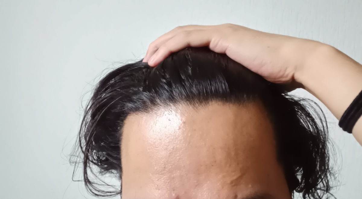 男性AGAイメージ画像