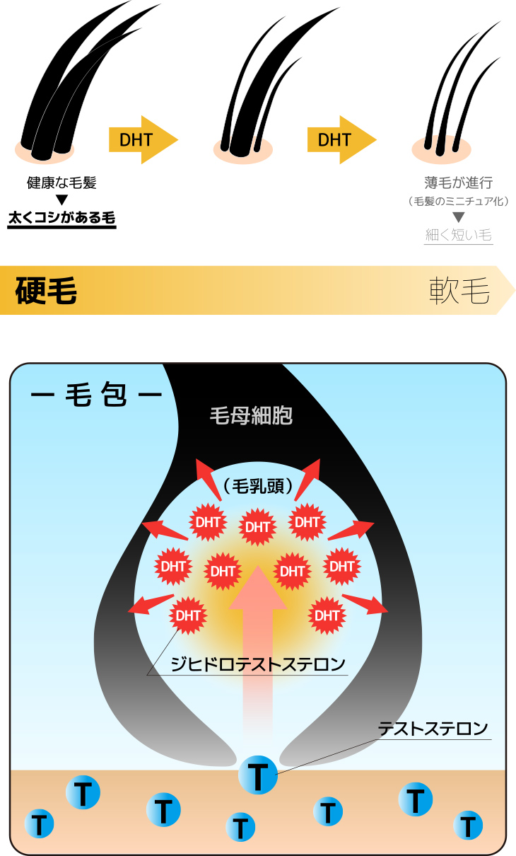 AGAの直接原因